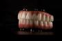 Full-arch dental prosthesis on implants.