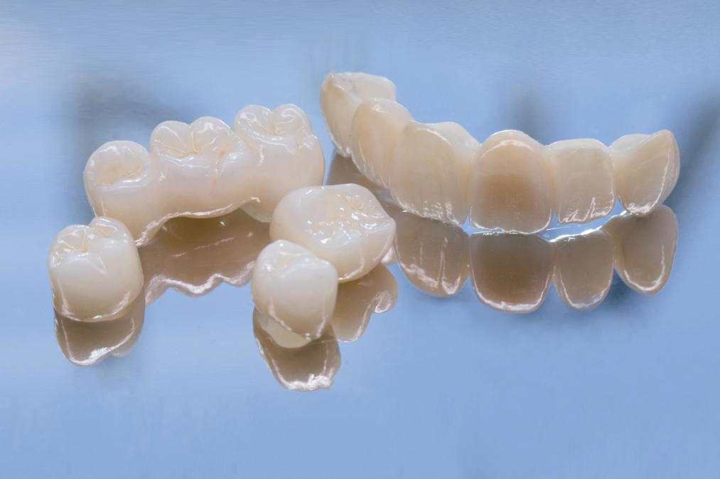 Several ceramic dental crowns and bridges reflecting on a blue surface.