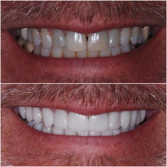 Before and after close-up of a man's smile, showing a dental transformation from discolored and gapped teeth to bright, perfectly aligned white teeth.