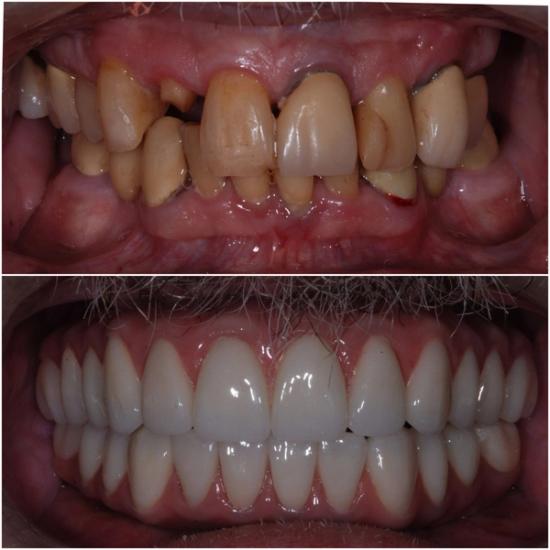 Before and after comparison of a mouth with severely damaged teeth (top) and perfectly restored, white teeth (bottom).