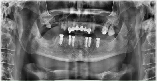 a black and white x-ray of a person 's teeth and gums .