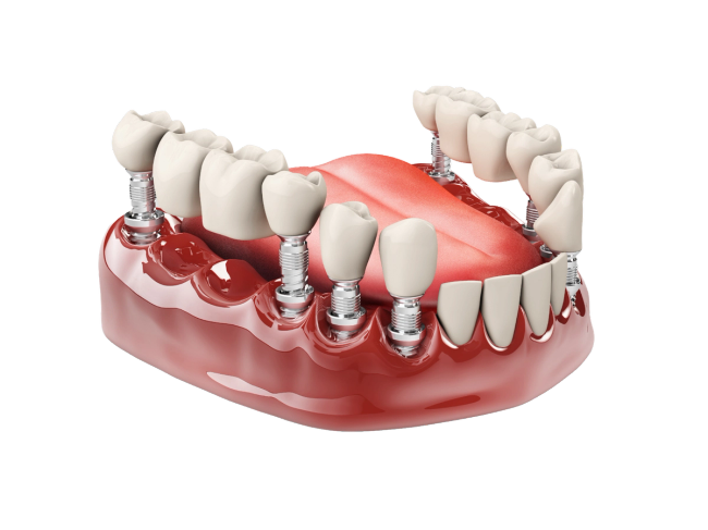 a computer generated image of a mouth with dental implants