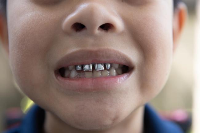 a close up of a child 's mouth with missing teeth .