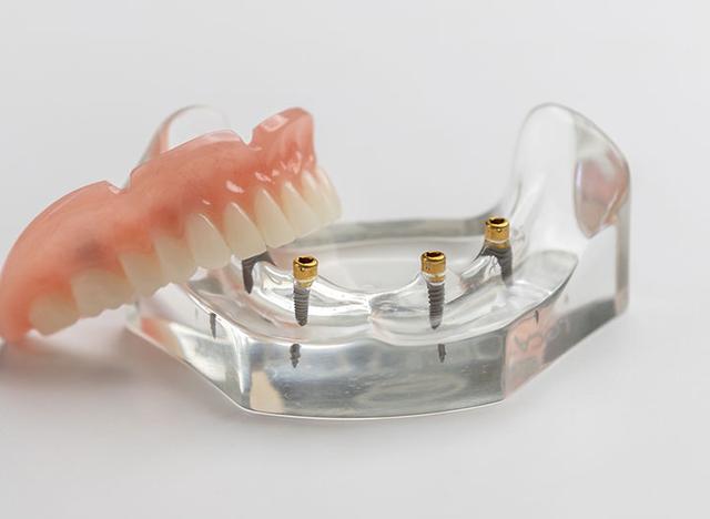 Dental implants and a full denture on a clear jaw model.