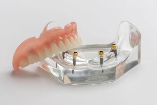 a model of a denture with dental implants on it .