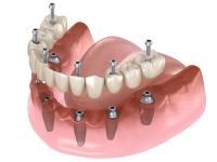 3D illustration of full mouth dental implants with prosthetic teeth, showing implants embedded in transparent gums.