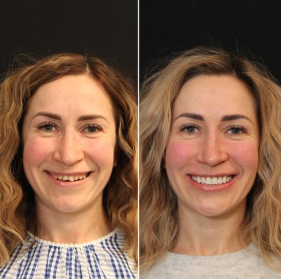 a before and after photo of a woman 's smile .