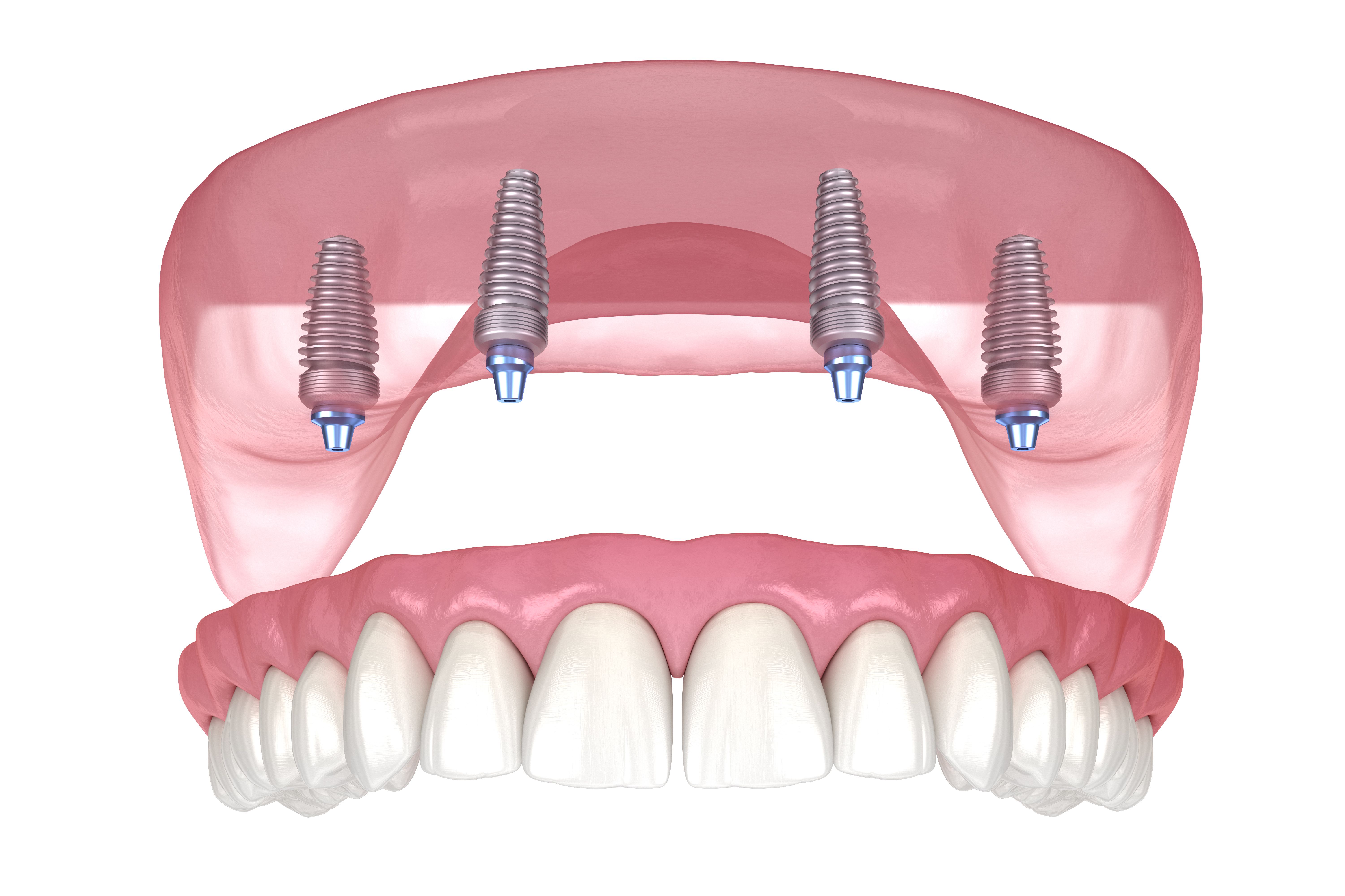 a 3d rendering of a full denture with four dental implants .