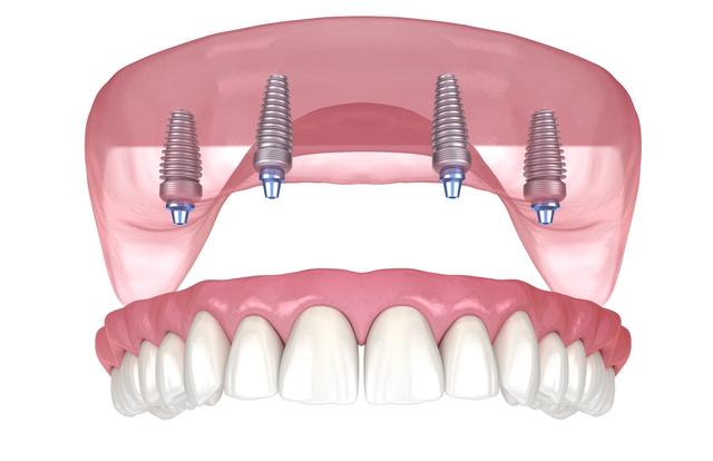 a 3d rendering of a full denture with four dental implants .