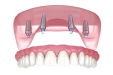 a 3d rendering of a full denture with four dental implants .