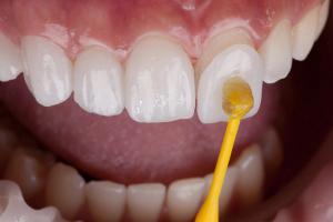 Close-up of a dental veneer being bonded to an upper front tooth with a yellow applicator.