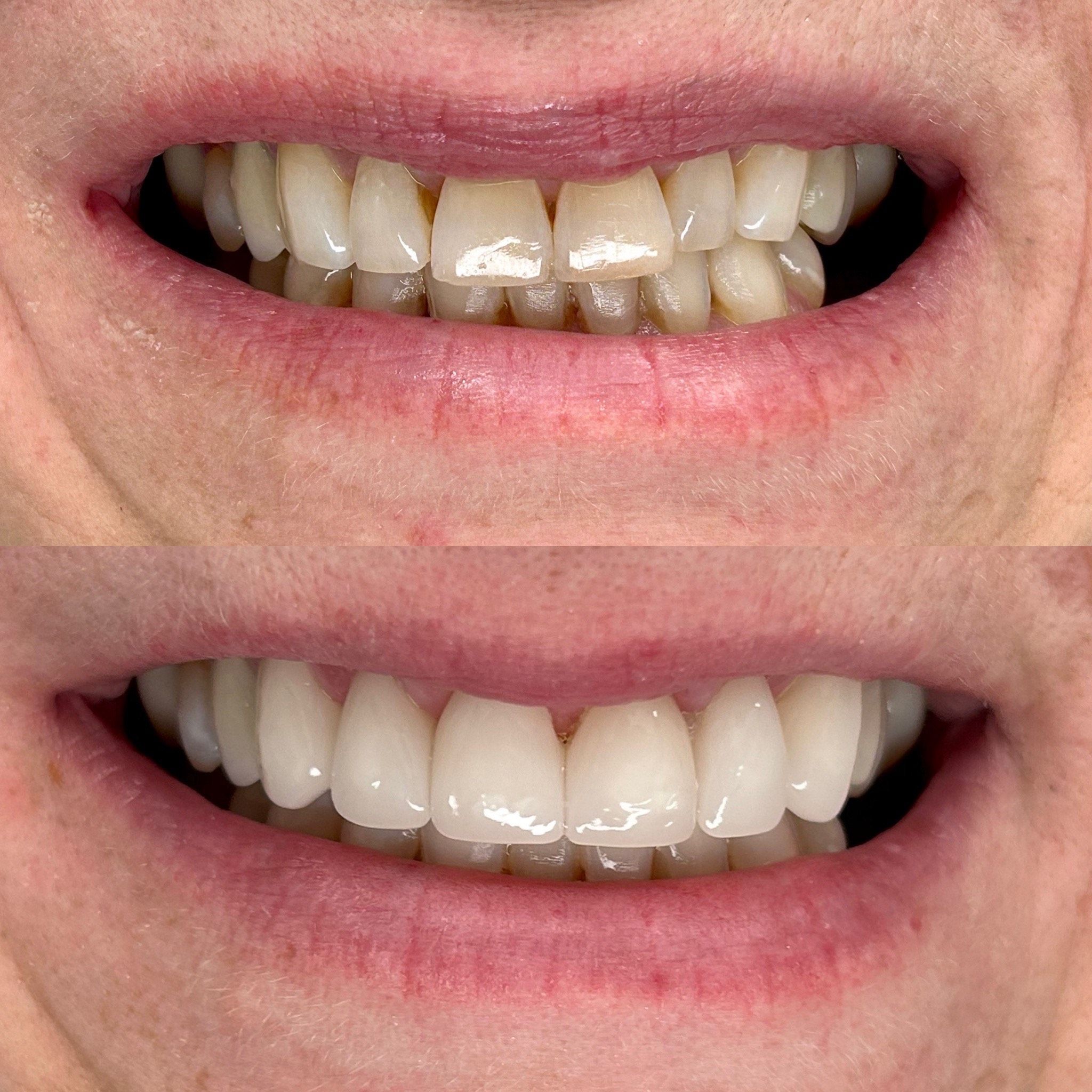 Before and after close-up of a person's mouth, showing discolored teeth above and bright, white teeth below.