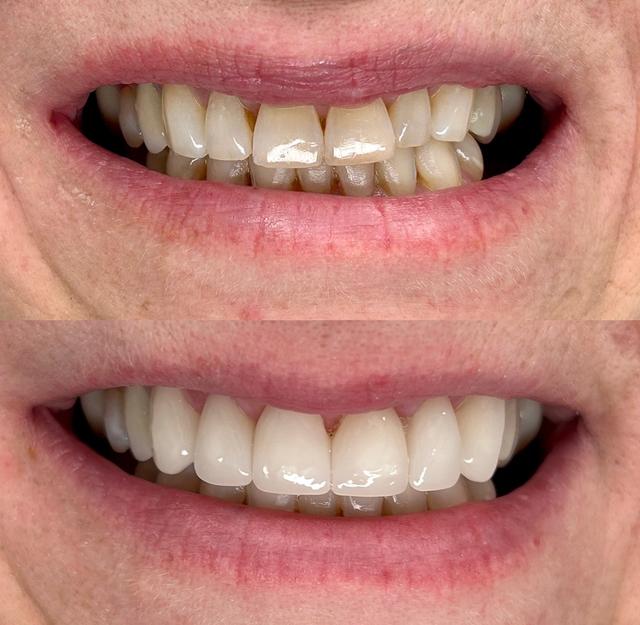 Before and after close-up of a person's mouth, showing discolored teeth above and bright, white teeth below.