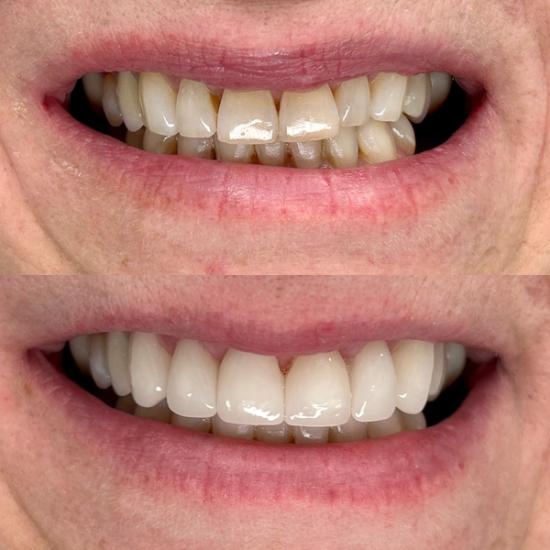 a before and after picture of a person 's teeth .