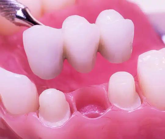 a close up of a dental bridge in a person 's mouth .