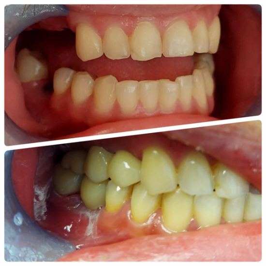 a before and after photo of a person 's teeth