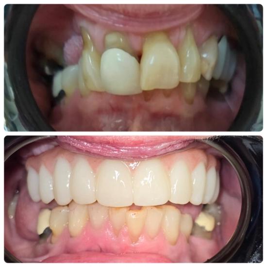 a before and after picture of a person 's teeth .