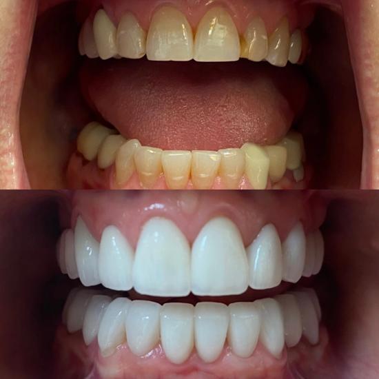 a before and after picture of a person 's teeth .