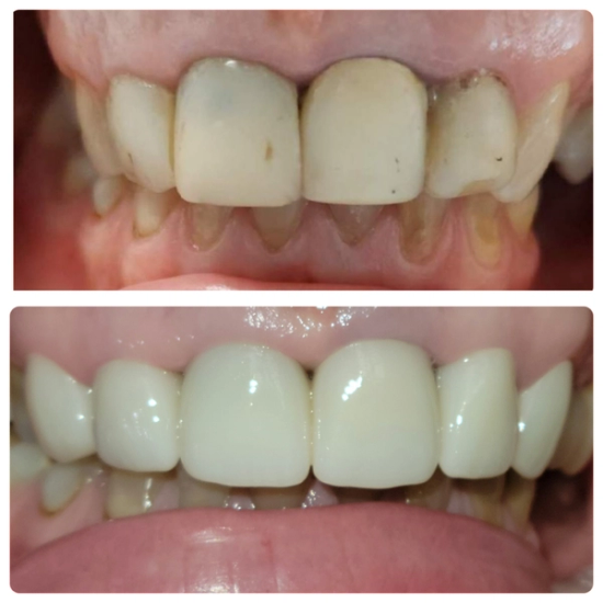 a before and after picture of a person 's teeth