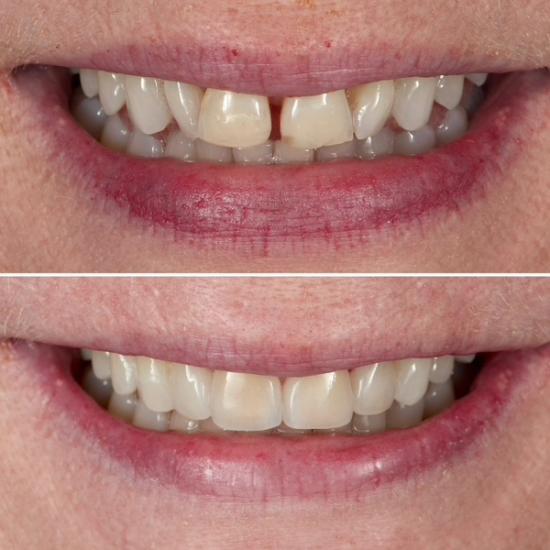 a before and after picture of a woman 's teeth .