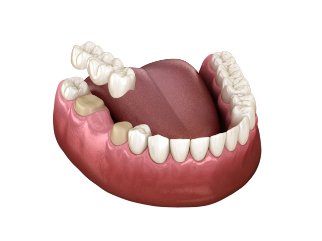 a computer generated image of a mouth with teeth and gums