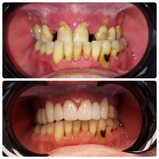 a before and after photo of a person 's teeth