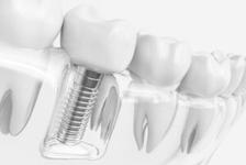 a close up of a dental implant in a tooth .