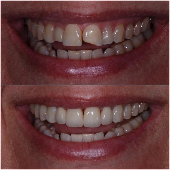 Before and after images of a smile, showing gapped and irregular front teeth repaired to a uniform, brighter appearance.
