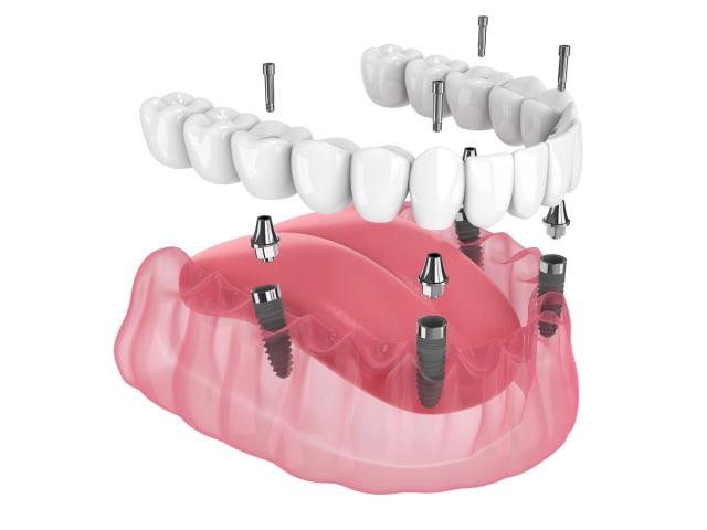 a 3d rendering of a full denture with dental implants .