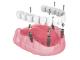 Exploded diagram of an all-on-4, full arch dental implant system, showing implants, abutments, and prosthetic teeth.