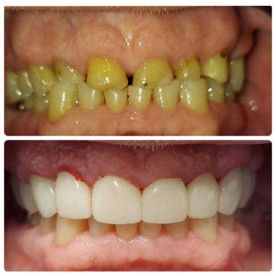 a before and after photo of a person 's teeth .