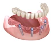 a computer generated image of a full denture with dental implants .