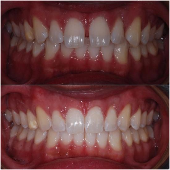 Before and after photos of teeth showing improved alignment and a closed front gap.
