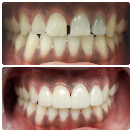 a before and after photo of a person 's teeth