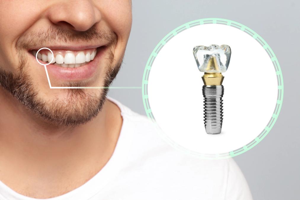 a man with a beard and a dental implant in his mouth .