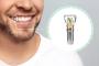 a man with a beard and a dental implant in his mouth .