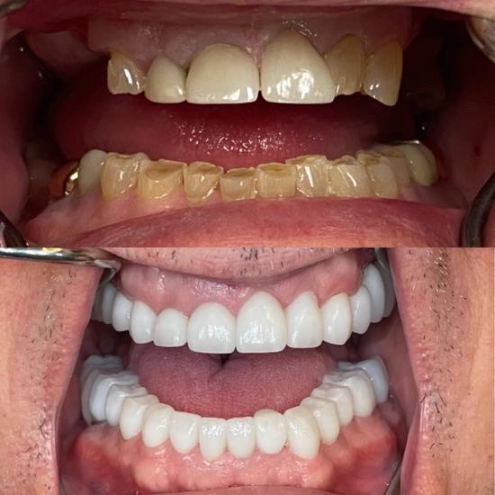 a close up of a person 's teeth before and after dental treatment .
