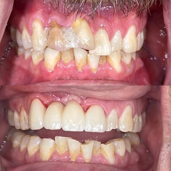 a close up of a man 's teeth before and after dental treatment .