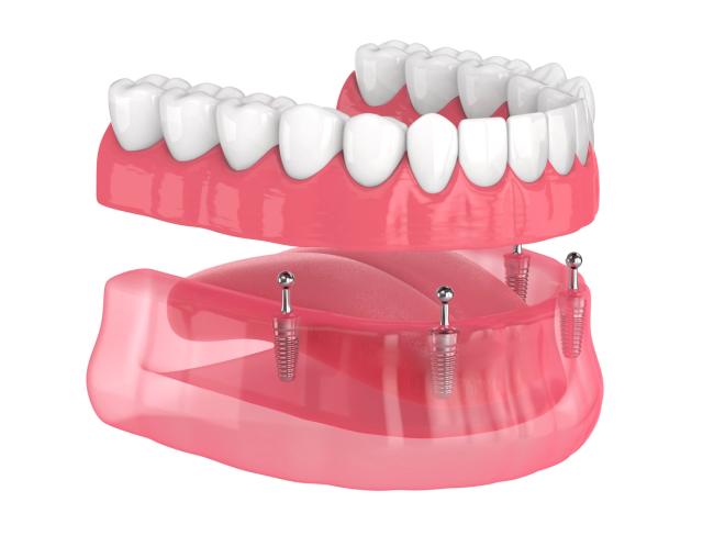 a 3d rendering of a full denture with dental implants .