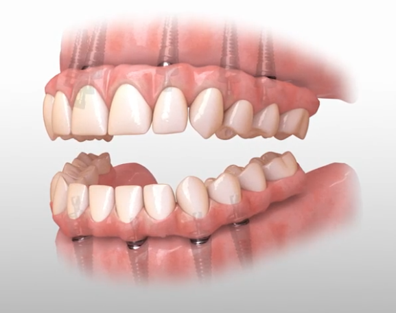 Full upper and lower dental arches with artificial teeth supported by visible dental implants.