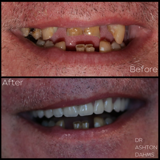 a before and after photo of a man 's teeth by dr ashton dahms