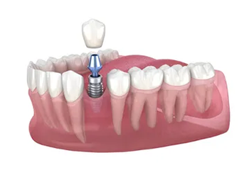 an illustration of a dental implant being placed in a tooth .