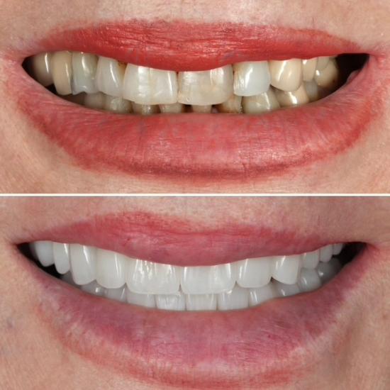 a before and after photo of a woman 's teeth .