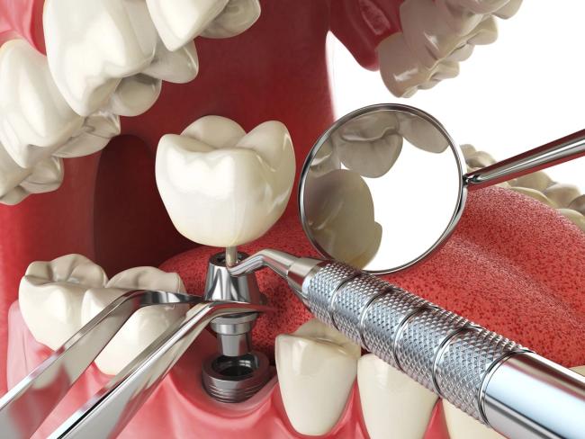 a 3d rendering of a dental implant being placed in a tooth .