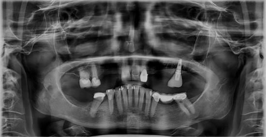 a panoramic x-ray of a person 's teeth and skull .