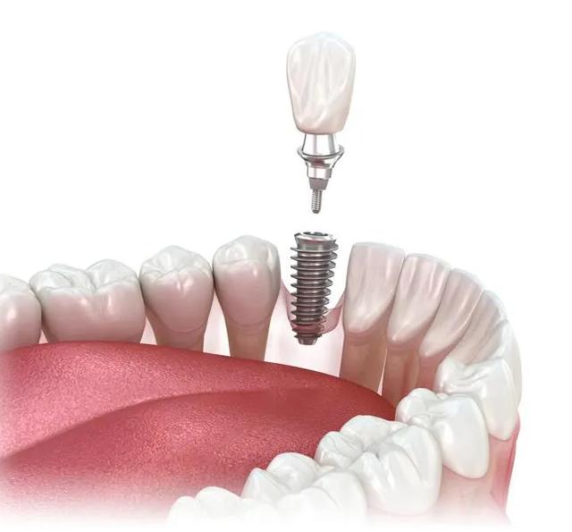 Illustration of a dental implant being placed in a jaw, showing the implant post, abutment, and crown.