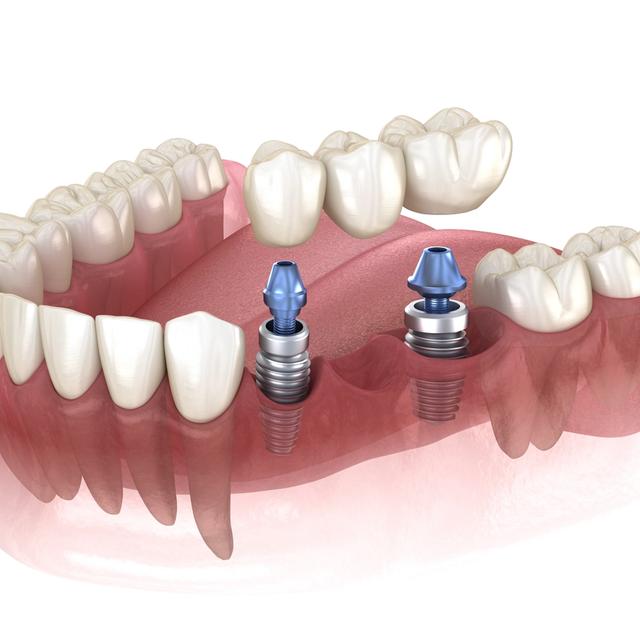 3D model of a lower jaw illustrating dental implants, a crown, and a dental bridge.