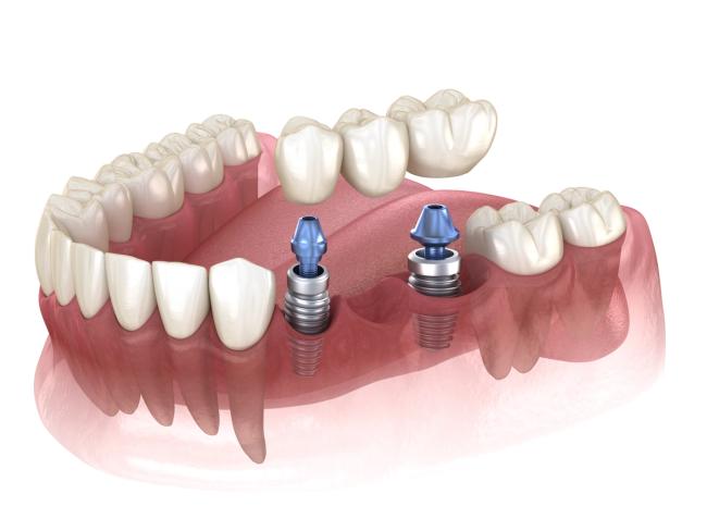 a computer generated image of a dental bridge with two dental implants .