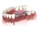 A 3D model of a lower jaw with two dental implants and a bridge.