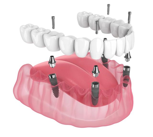 a 3d rendering of a full denture with dental implants .